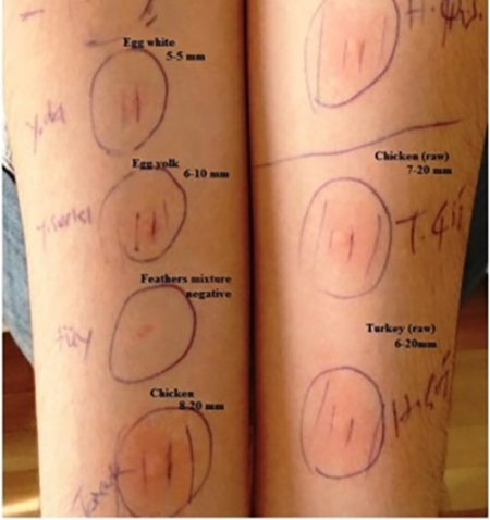 آلرژی به تخم مرغ, تشخیص آلرژی به تخم مرغ