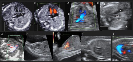 اکوی قلب جنین