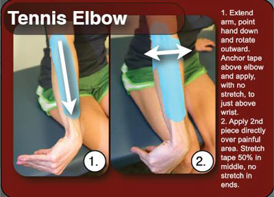 بیماری سندرم آرنج تنیس بازان,درمان بیماری‌ آرنج‌ تنیس‌بازان‌
