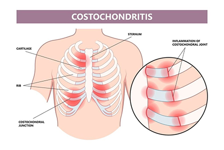 کوستوکندریت, علت ورم قفسه سینه چیست, درد قفسه سینه یکی از نشانه های کوستوکندریت