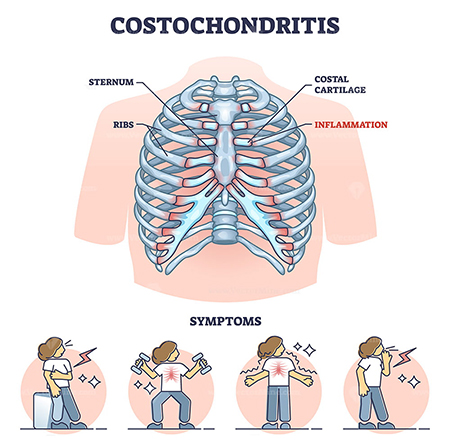 کوستوکندریت, علت ورم قفسه سینه چیست, عوارض کوستوکندریت