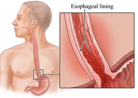ازوفاژیت, ازوفاژیت التهاب مری