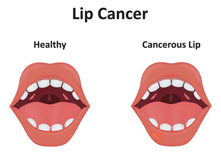 سرطان لب, علائم اولیه سرطان لب, بیوپسی یکی از راههای تشخیص سرطان لب 