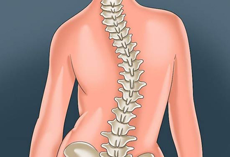 اسکولیوز،اسکولیوز چیست،بیماری اسکولیوز