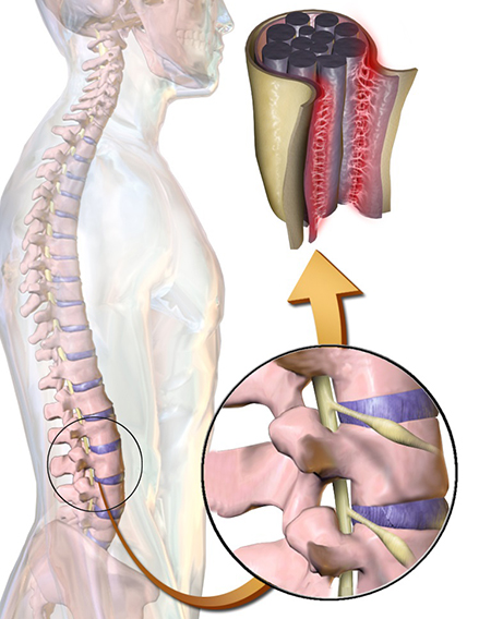 آراکنوئیدیت, بیماری Arachnoiditis