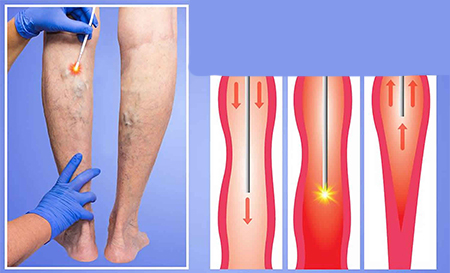 لیزر درون وریدی, درمان واریس, درمان رگهای واریسی