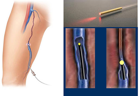 لیزر درون وریدی, درمان واریس, EVLA درمان موثری برای واریس است