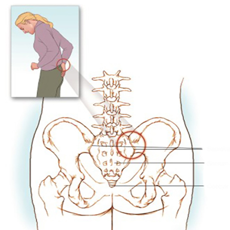 درد مفصل ساکروایلیاک, درمان درد مفصل ساکروایلیاک,علل بروز درد در مفصل ساکروایلیاک