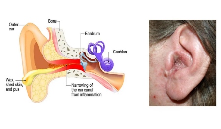 بیماری گوش شناگر, بیماری گوش شناگران, قرمزی و تورم گوش از علایم گوش شناگر