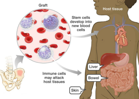 بیماری پیوند در مقابل میزبان, بیماری پیوند علیه میزبان