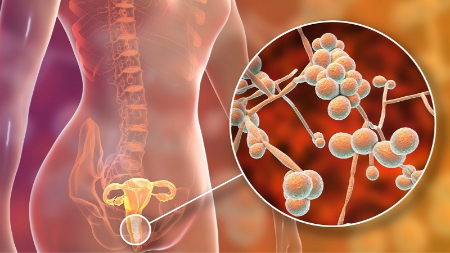 درمان خانگی عفونت های قارچی واژن, عفونت های قارچی واژن