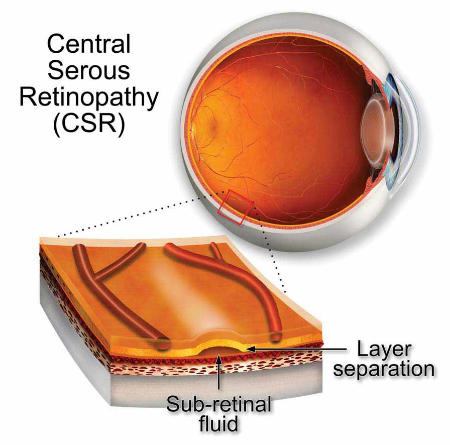 رتینوپاتی سروز مرکزی, دلایل بروز رتینوپاتی سروز مرکزی