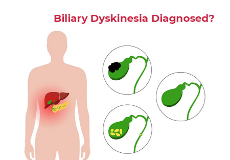 دیسکینزی صفراوی, تشخیص دیسکینزی صفراوی