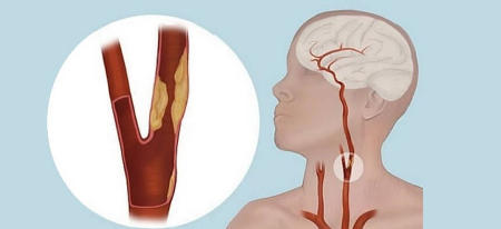 اندارترکتومی کاروتید, اندآرترکتومی کاروتید