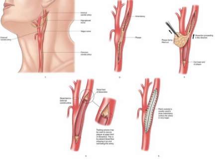 اندارترکتومی کاروتید, اندآرترکتومی کاروتید