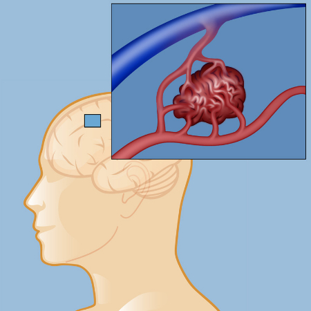 avm مغزی, بیماری avm مغزی