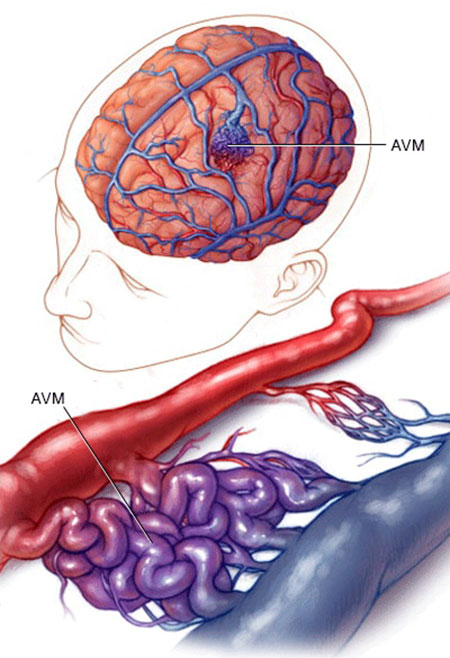 avm مغزی, بیماری avm مغزی