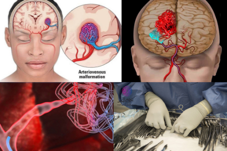 avm مغزی, بیماری avm مغزی