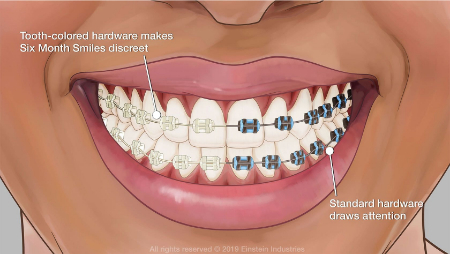 ارتودنسی همرنگ دندان, ارتودنسی با براکت های هم رنگ دندان