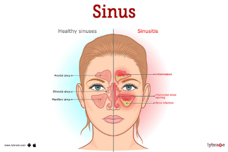 سینوس‌های پارانازال چیست, عفونت سینوس‌های پارانازال