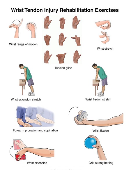 ورزش درمانی تاندون مچ دست آسیب دیده, فیزیوتراپی تاندون مچ دست آسیب دیده, کشیدگی تاندون مچ دست