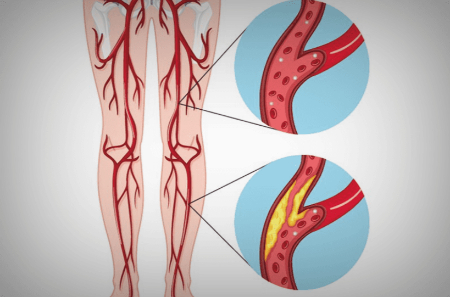 گرفتگی شریان پا, دلایل انسداد عروق پا