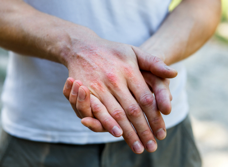 عوامل تشدید درماتیت آتوپیک, محرک‌های اگزما