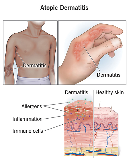 عوامل تشدید درماتیت آتوپیک, محرک‌های اگزما