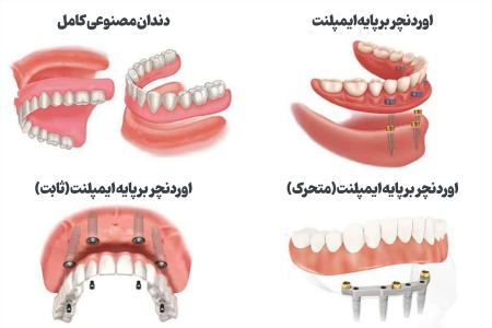 اوردنچر با ایمپلنت برای سالمندان
