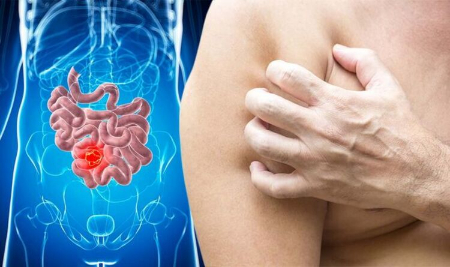 نشانه های پوستی سرطان روده بزرگ, علائم نادر پوستی سرطان کولورکتال